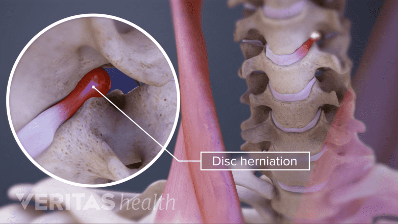 Illustration showing laterally herniated cervical disc.