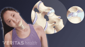 Medical illustration of the gas bubbles within the cervical facet joints that lead to crepitus