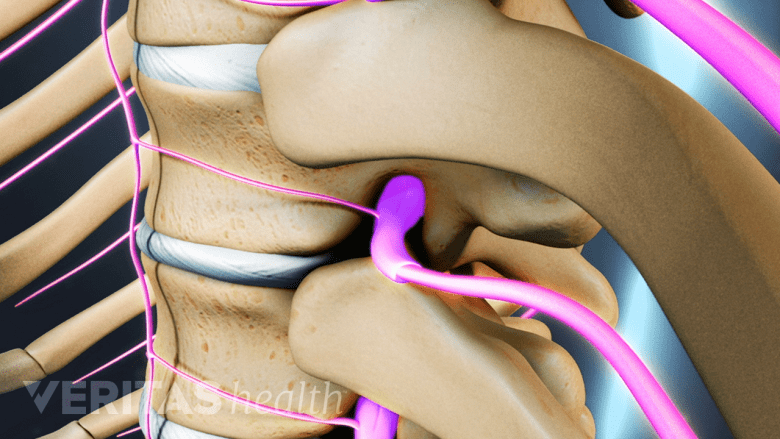 Sagittal 3D view of the thoracic spine with nerves in purple.