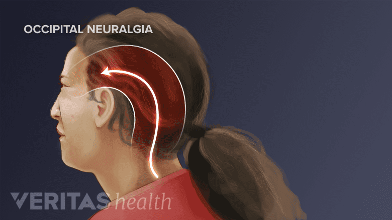 Una porción de la cabeza dolorosa.