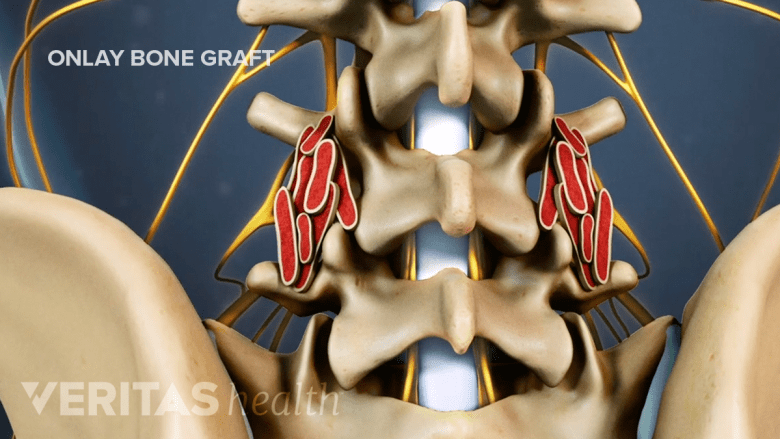 Illustartion showing lumbar posteriolateral gutter fusion.