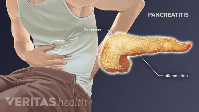 Medical illustration of pancreatitis