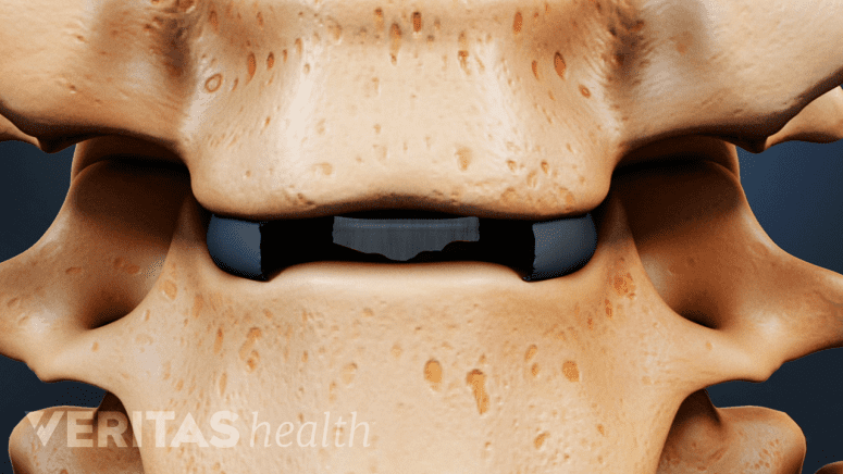 Anterior view of artificial disc inserted between two cervical vertebrae