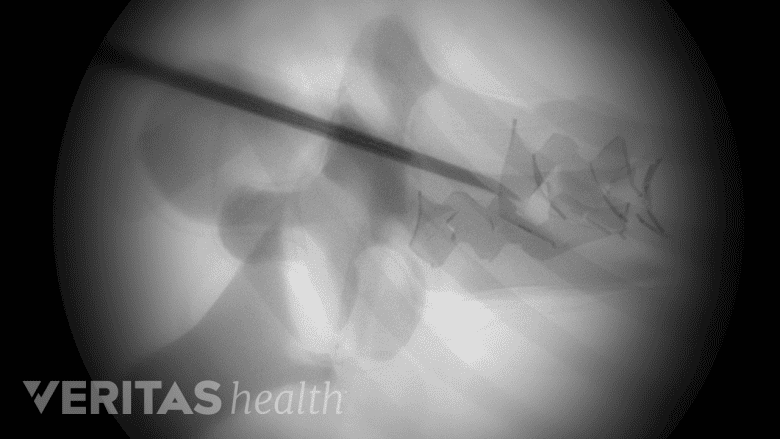 Illustration showing fluoroscopic x-ray.