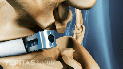 A cage is an implant that provides more normal spacing between vertebrae.