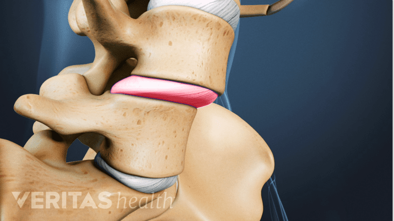 Close-up view of a 3D rendering of the lumbar spine, with a slipped disc highlighted in red.