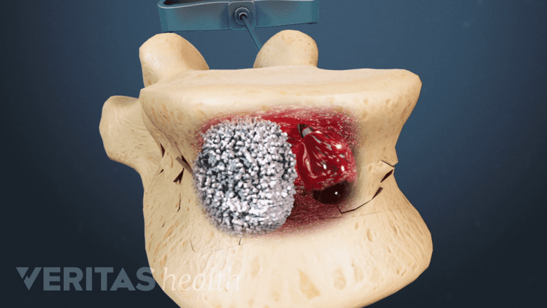 Illustration showing bone cement in the cavity during kyphoplasty.