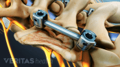 Fusion rods in the lumbar spine.