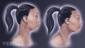 Illustration of the effect of forward head posture on the neck muscles