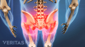 Medical illustration of the torso and upper legs. The hips and buttocks are highlighted in red indicating pain.
