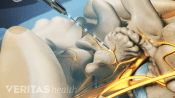 Lumbar radiofrequency neurotomy electrical current