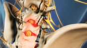 Medical illustration showing radiofrequency neurotomy in the lumbar spine