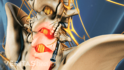 Medical illustration of the lumbar spine showing bone spurs on the facet joints