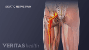 Medical illustration showing the sciatic nerve down the leg
