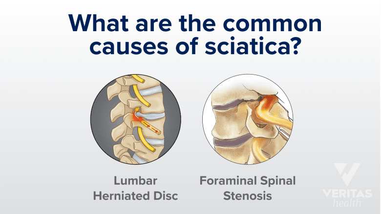 Common causes of Sciatica.