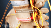 Sciatica pain caused by disc degeneration.