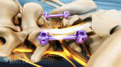 Posterior view of the lumbar spine showing screws and rods from fusion.