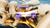 Posterior view of the lumbar spine showing screws and rods from fusion.