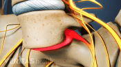 Spondylolisthesis in the lumbar spine