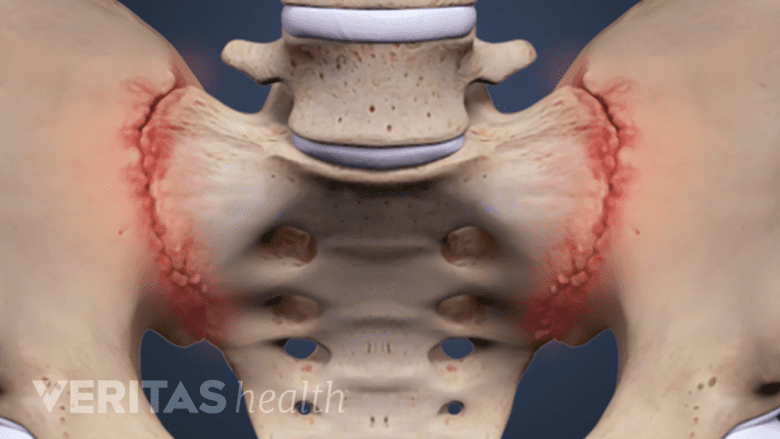 An illustration showing SI joint highlighted in red.