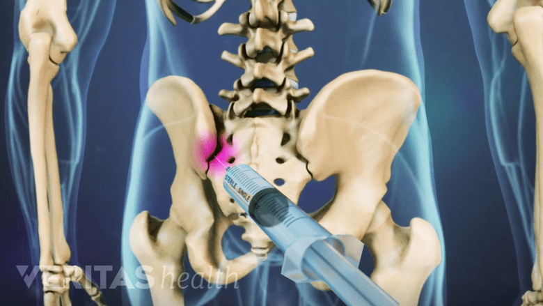 An illustration showing a syringe injected into the SI joint highlighted in red.