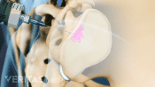 Profile view of the pelvis showing an sacroiliac joint (SI) injection