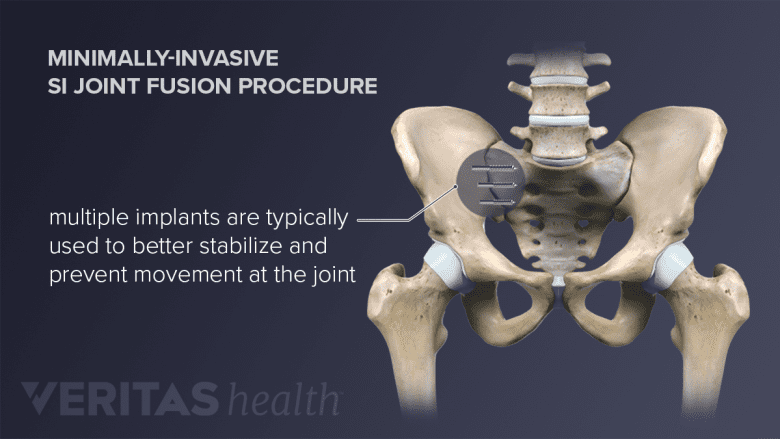 The most common method of sacroiliac joint fusion is a minimally-invasive procedure.