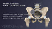 A sacroiliac joint fusion eliminates movement at the sacroiliac joint by grafting the ilium and sacrum together.