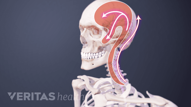 Medical illustration showing cervicogenic headache.