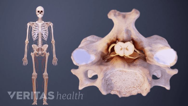 Spinal cord compression in the neck causing nerve damage in the body.