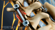 Medical illustration showing screws and rods in the spine