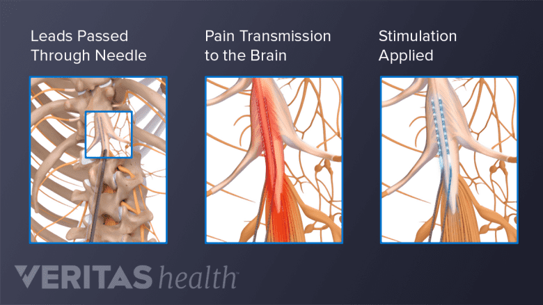 Electrical stimulation given to the spinal cord.