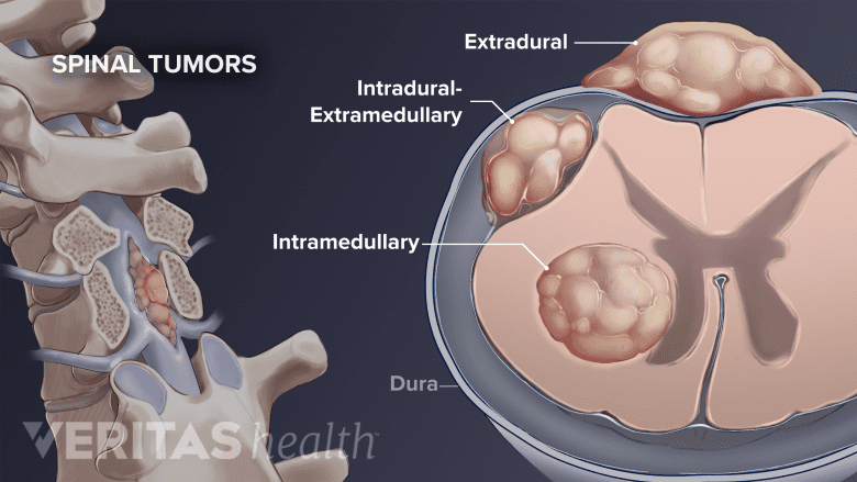 illustration showing veryebral spine with tumor, and cross section of  spinal cord with different tumors.