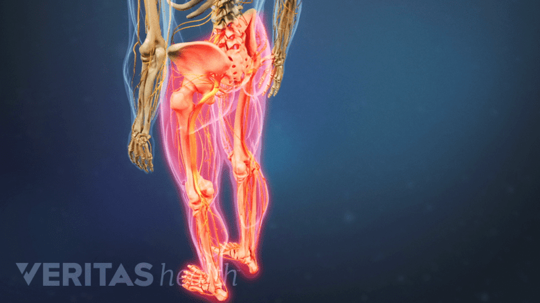 An illustration showing severe pain on both the lower limbs.
