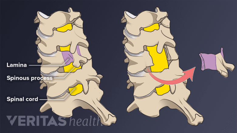 Cutting bone in cervical laminectomy