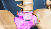 Skeletal view of the lumbar spine with L5 and S1 highlighted