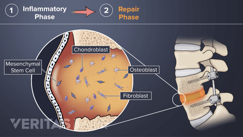 The repair phase of bone healing from a fusion.