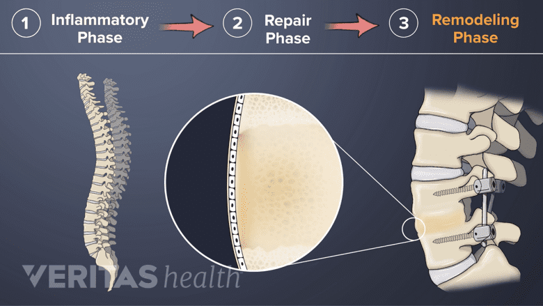 Remodeling phase of a spinal fusion recovery.