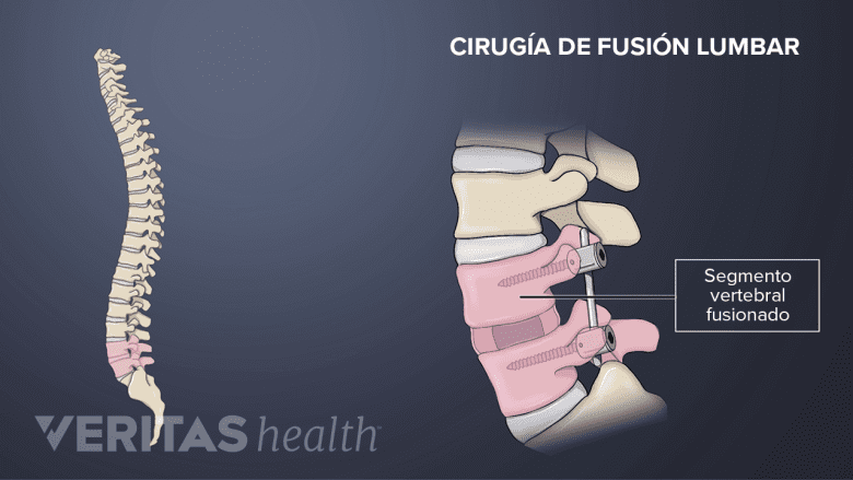 Cirugía de fusión lumbar.