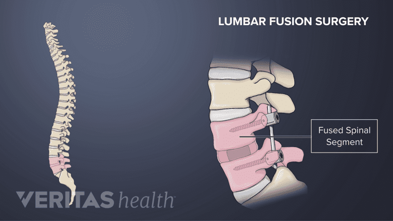 Posterior view illustration of a lumbar fusion.