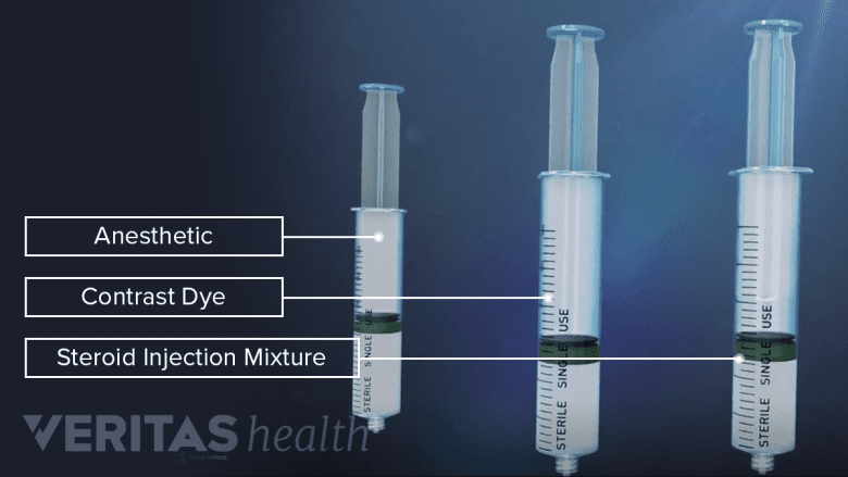 An image showing components of piriformis injection.