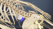 Posterior view of the spinal cord stimulator in the lumbar spine.