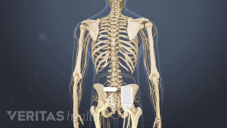 Spinal cord stimulator unit and leads in the spine.