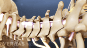 Spinal cord leads in the cervical spine.