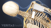 Medical illustration showing the placement of a spinal cord stimulator