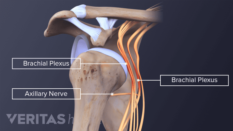 An illustration showing brachial plexus impingement.