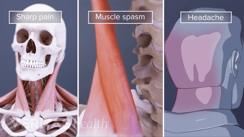 Illustration showing pain, muscle spasm, and headache.