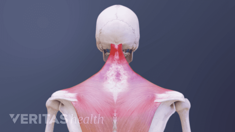 3D image of neck pain.