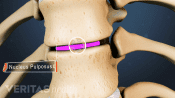 Anterior view of a thoracic herniated disc highlighting the nucleus pulposus.