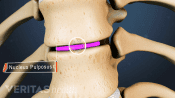 Anterior view of a thoracic herniated disc highlighting the nucleus pulposus.